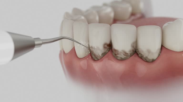 Trusted Wisdom Tooth Removal service in North Zanesville, OH - Dentist Open Now